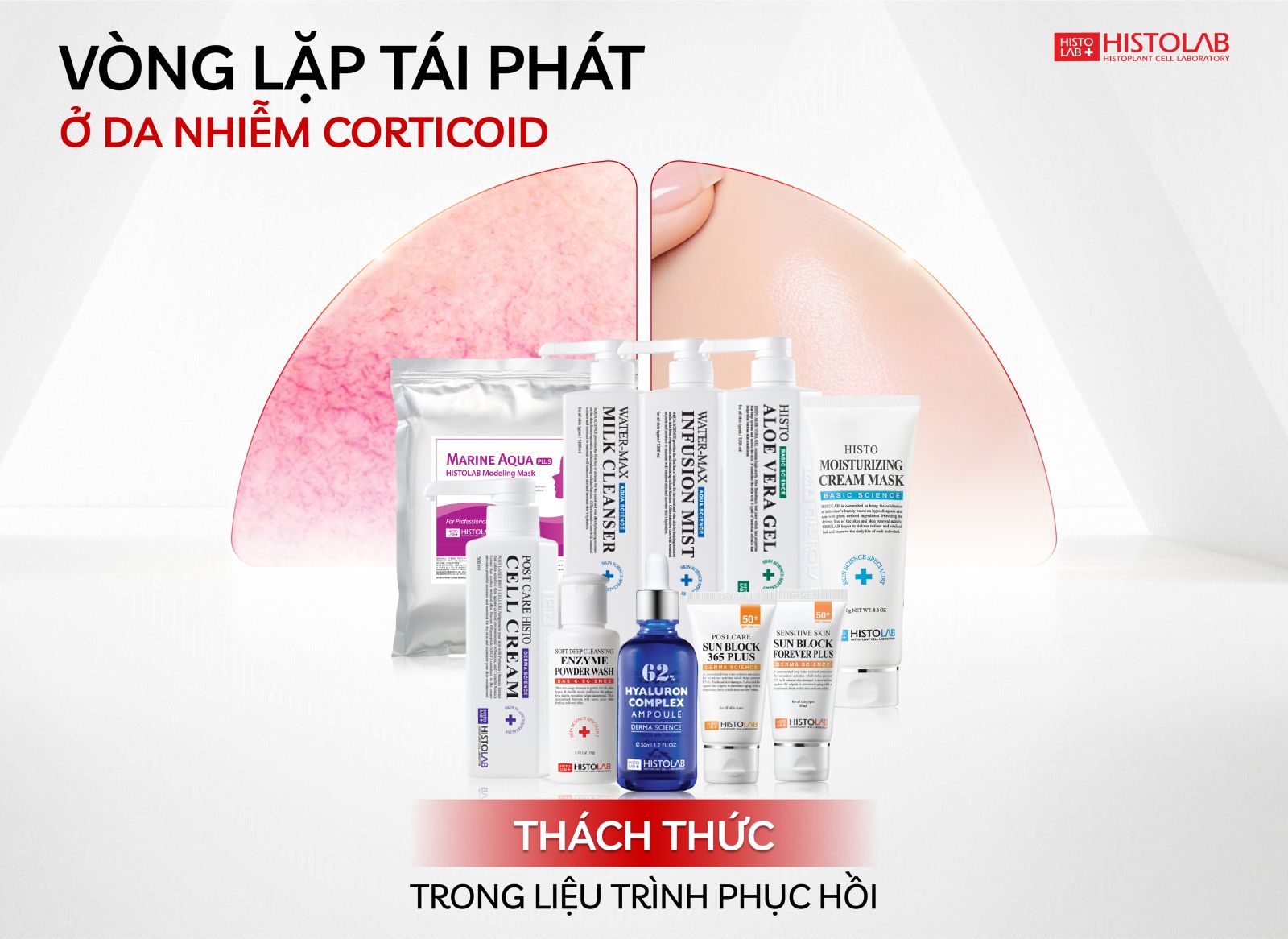 vong-lap-tai-phat-o-da-nhiem-corticoid